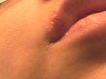 Female Cold Sore HSV-2