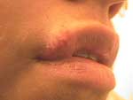 Female Cold Sore HSV-2