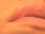 Female Cold Sore HSV-2