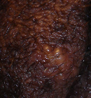 herpes-picture1.jpg