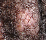 Female HSV-2 (day 4)