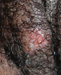 Female HSV-2 (day 5)