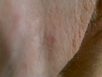 Female Genital Herpes HSV-1