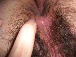 Female Genital HSV-2