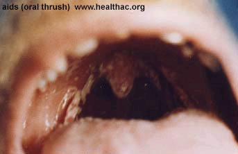 AIDS - Oral Thrush