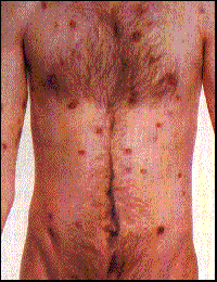 Effects of AIDS on the trunk of body