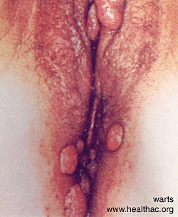 Female Genital Warts HPV Picture
