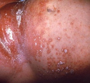 Pictures of Scabies, Transmission, Symptoms, Treatment