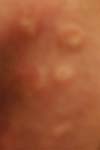 Genital Herpes Picture (female)