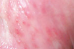 Genital Herpes Picture (male)