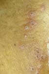 Genital Herpes Picture (female)