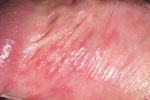 Genital Herpes Picture (male)