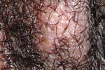 Genital Herpes Picture (male)