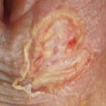 Genital Herpes Picture (female)