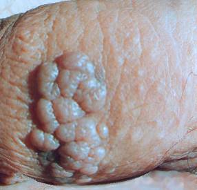 White Male Genital Warts HPV Photo