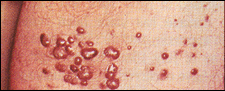 AIDS HIV Picture - Kaposi's sarcoma on the leg