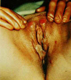 Pictures of Female Syphilis Symptoms