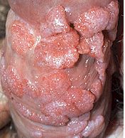 White Male Genital Warts HPV Photo
