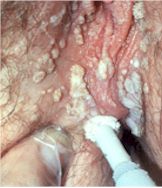 Female Genital Warts HPV Photo