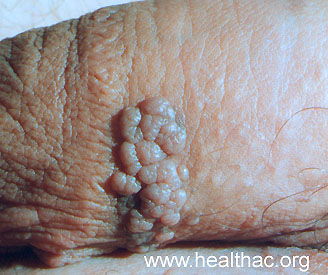 White Male Genital Warts HPV Photo