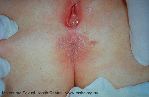 Anal Warts Pictures