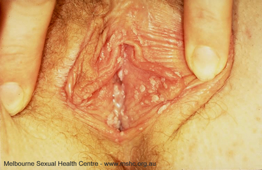 Genital Warts Dangers It Pose To Your Health