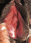 Female Gonorrhea Picture