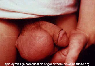 Epididymitis, a complication of gonorrhea