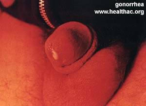 Male Gonorrhea Photos