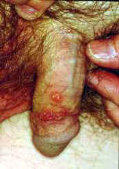 Male Herpes Photo