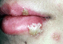 Herpes Picture - HSV1 on the lip