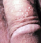 Photo of herpes blisters on male