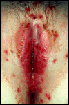 Female Herpes Picture