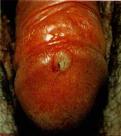 Pictures of Male Syphilis Symptoms