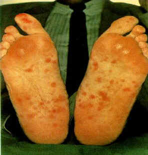 Rash caused by Syphilis on Feet