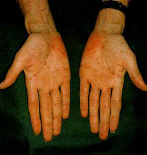 Rash caused by Syphilis on Hands