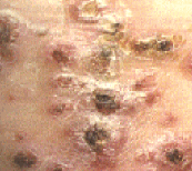 Syphilis Picture