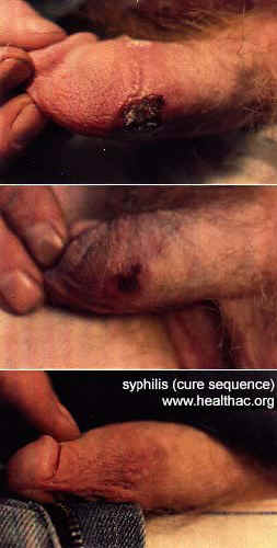 Syphilis Treatment Photos