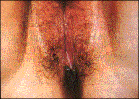 vaginaldischargetrich - Herpes & Coldsores Support Network