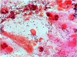 Microscopic image of Bacterial Vaginosis