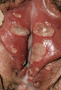 Ulcers Images, Pictures & Photos - CrystalGraphics