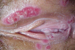 Chancroid Pictures 7 - Herpes & Coldsores Support Network Chancroid in vagina