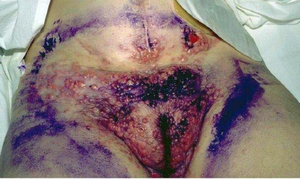 Pictures of severe AIDS infection symptoms.