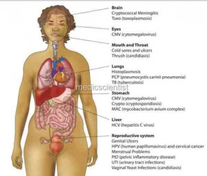 AIDS / HIV diagram of effects in a woman