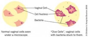 bacterial vaginosis cells