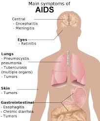 Symptoms of Acquired Immune Deficiency Syndrome (AIDS)