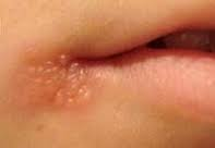 Cold sores on lip HSV1