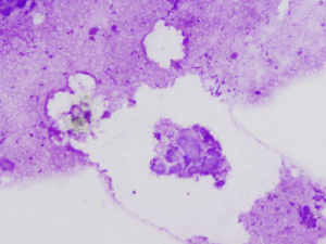 Lymphogranuloma inguinale