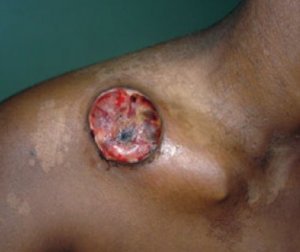 Lesion from Lymphogranuloma