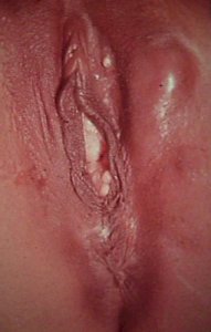 Female with Lymphogranuloma inguinale